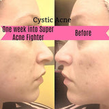 Super Acne Fighter / Organic Acne Treatment / Acne - Beauty Relemay